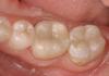 CEREC® Crown and Inlay