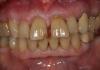 Anterior Case Before - chipped teeth, discolorations present